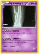 my broke leg ;(