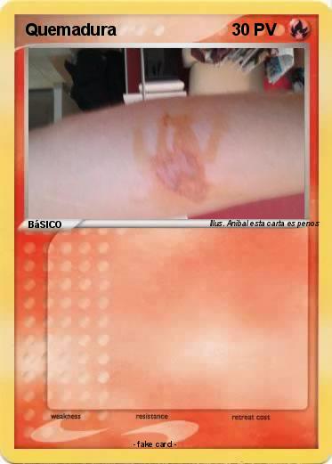 Pokemon Quemadura