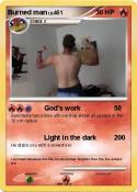 Burned man